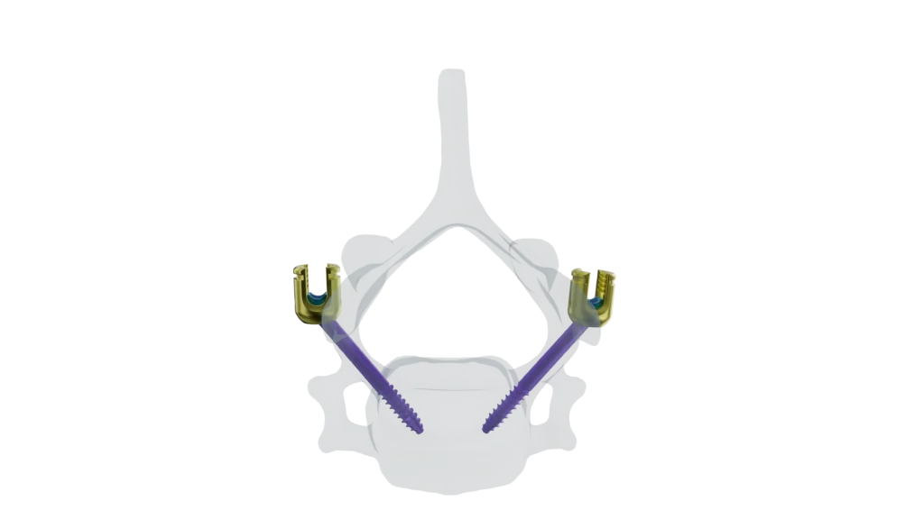 107 INFINITY - Vertebra